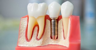 Имплантация зубов Тюмень - цена от 16834 руб.