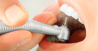 Пломбирование зубов Тюмень цена от 2505 руб. Стоматология ДокторЗуб